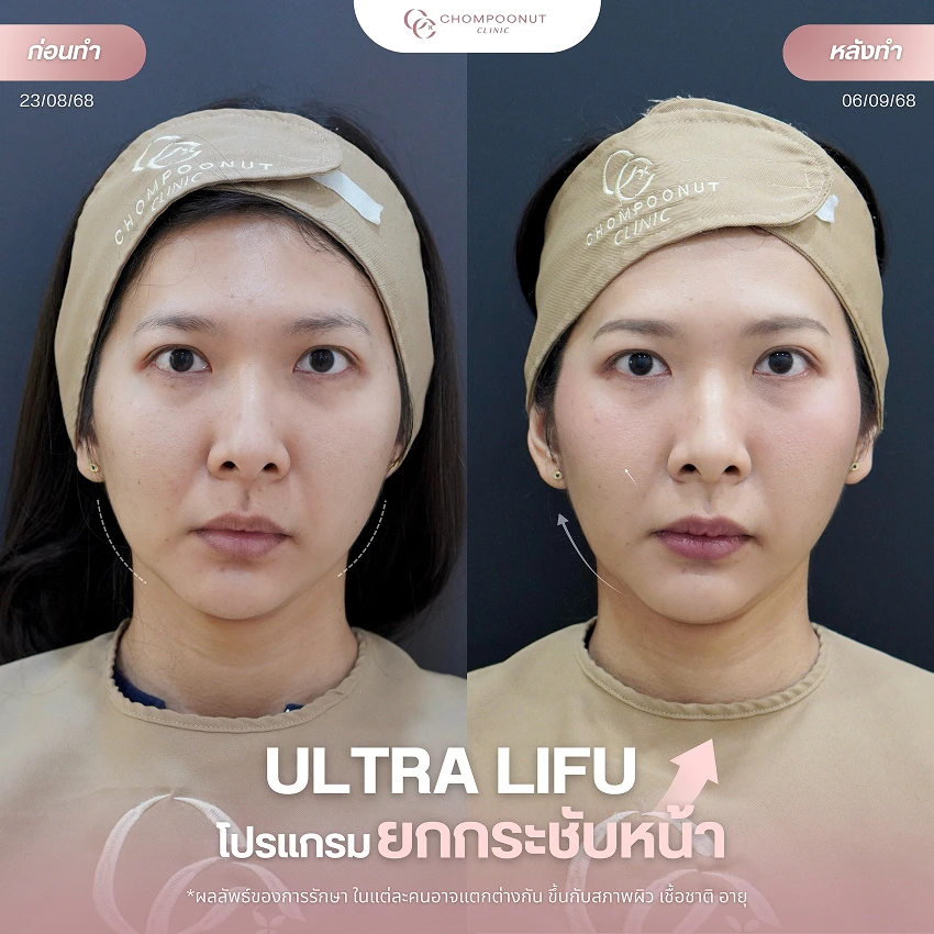 รีวิว Ultra LIFU ชมพูนุชคลินิค นครปฐม