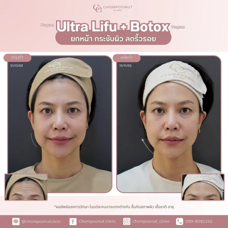 รีวิว Ultra LIFU + Botox ลดปัญหาผิวหย่อนคล้อย คลินิกผิวหนังนครปฐม