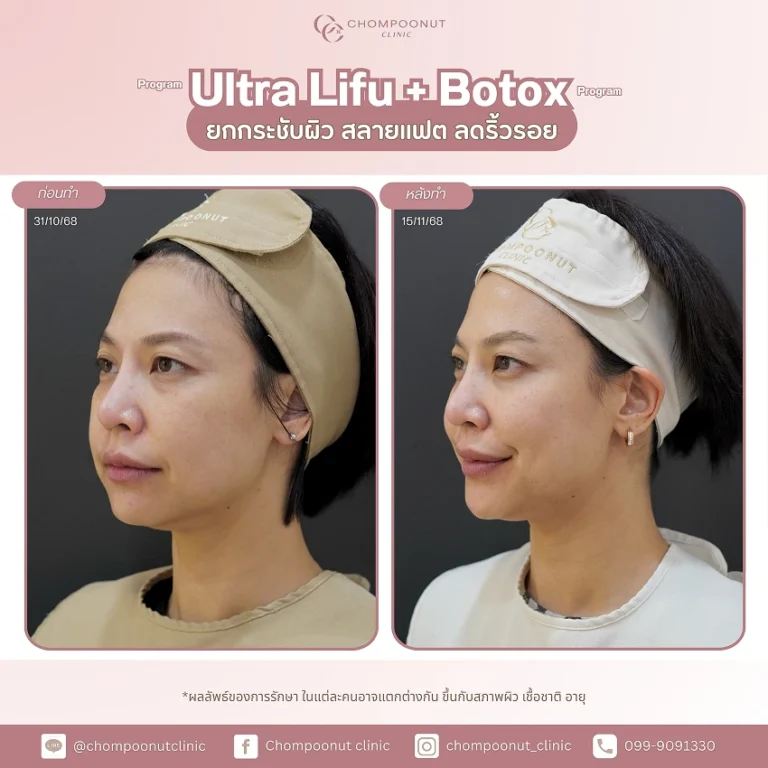 ภาพความประทับใจหลังทำโปรแกรม รีวิว Ultra LIFU + Botox ยกกระชับผิวหน้า