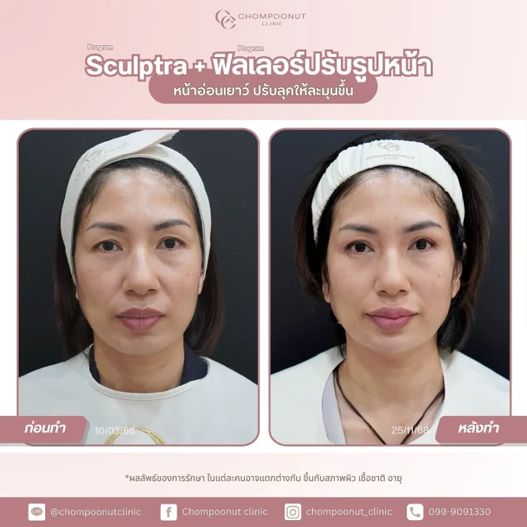 รีวิวฉีดฟีลเลอร์ปาก ชมพูนุทคลินิก นครปฐม ฉีดปาก