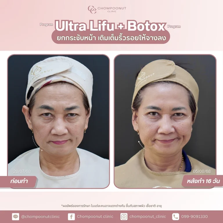 ผลลัพธ์หลังรับบริการ รีวิว Ultra LIFU + Botox ฟื้นฟูผิวหน้าอ่อนเยาว์