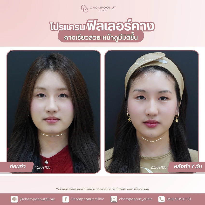 รีวิวฉีดฟีลเลอร์คาง ชมพูนุชคลินิค นครปฐม