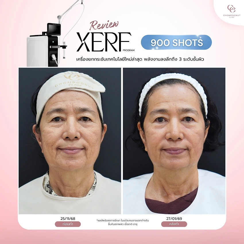 รีวิว XERF ชมพูนุชคลินิค นครปฐมรีวิว Sculptra ชมพูนุชคลินิค นครปฐม