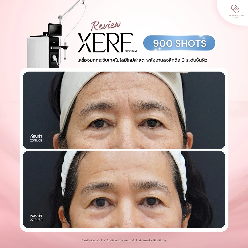รีวิว XERF ชมพูนุชคลินิค นครปฐมรีวิว Sculptra ชมพูนุชคลินิค นครปฐม