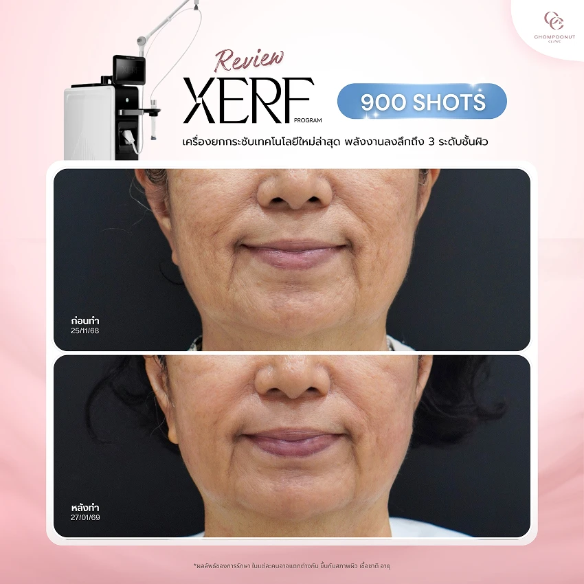 รีวิว XERF ชมพูนุชคลินิค นครปฐมรีวิว Sculptra ชมพูนุชคลินิค นครปฐม
