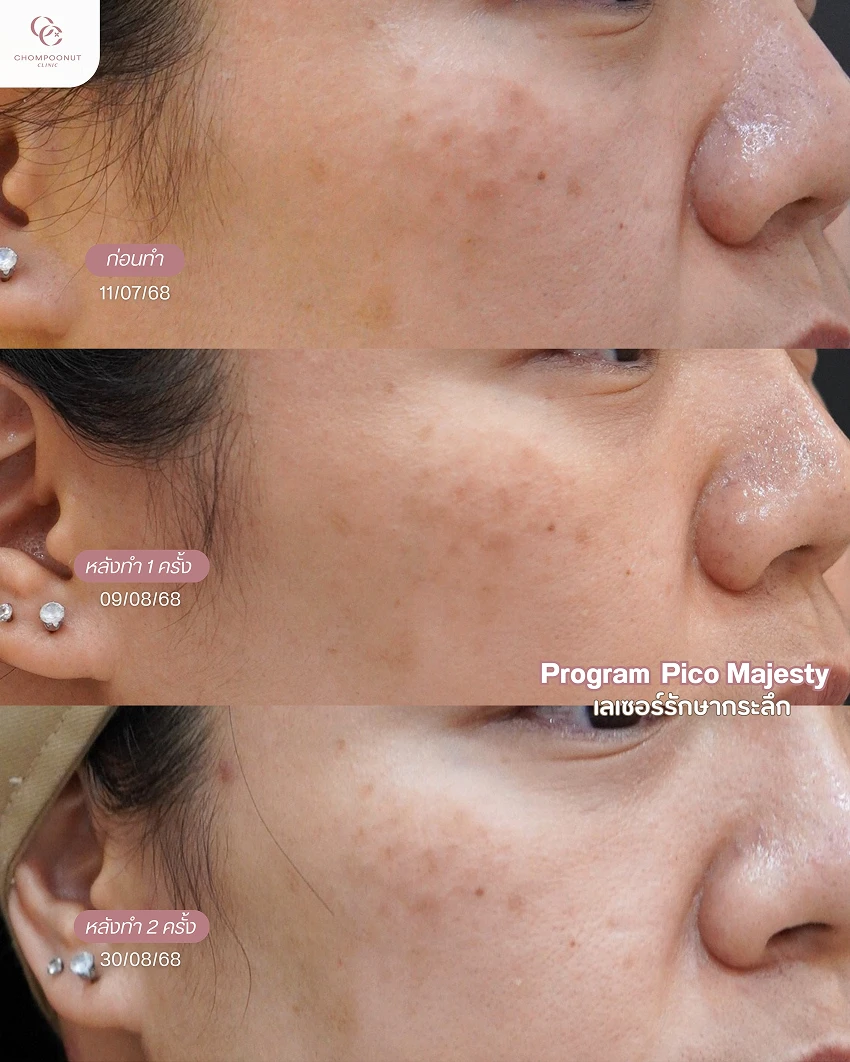 รีวิว Pico Majesty ฝ้า กระ ชมพูนุชคลินิค นครปฐมรีวิว Sculptra ชมพูนุชคลินิค นครปฐม