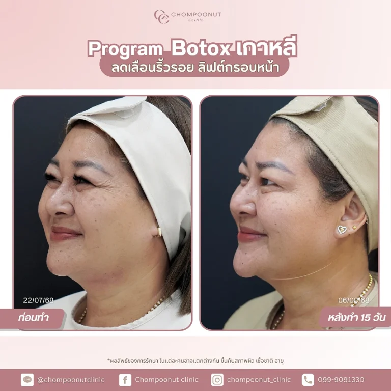 รีวิวฉีด โบท็อกซ์เกาหลี ชมพูนุชคลินิค นครปฐม Botox