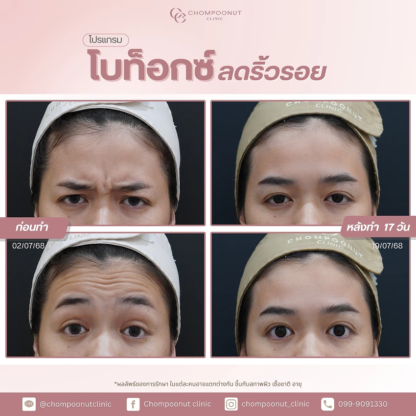 รีวิวฉีด โบท็อกซ์ลดริ้วรอย ชมพูนุชคลินิค นครปฐม Botox