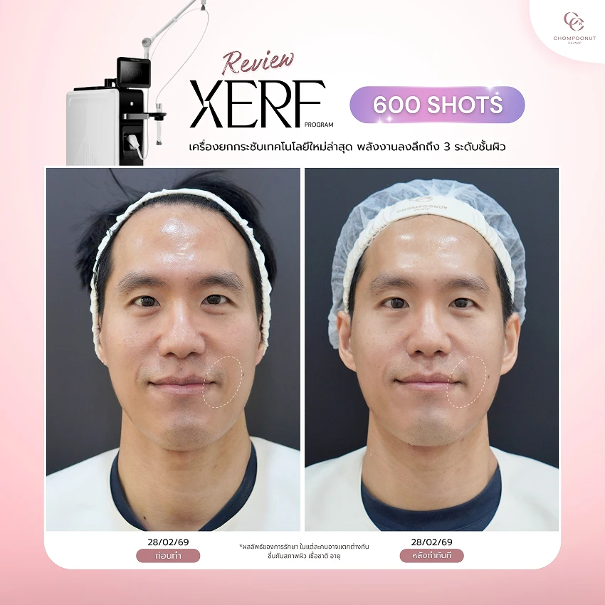 รีวิว XERF ชมพูนุชคลินิค นครปฐมรีวิว Sculptra ชมพูนุชคลินิค นครปฐม