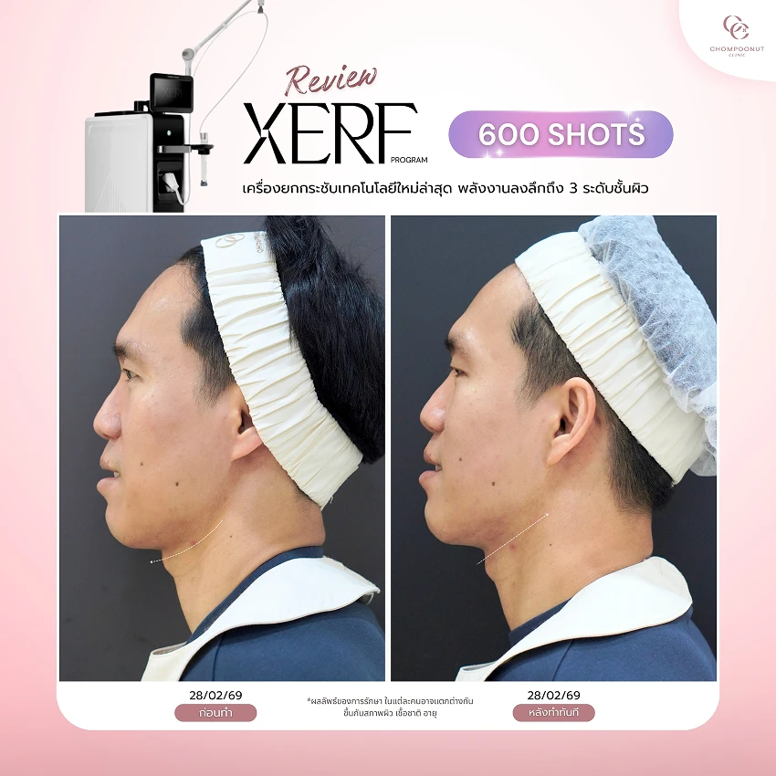 รีวิว XERF ชมพูนุชคลินิค นครปฐมรีวิว Sculptra ชมพูนุชคลินิค นครปฐม