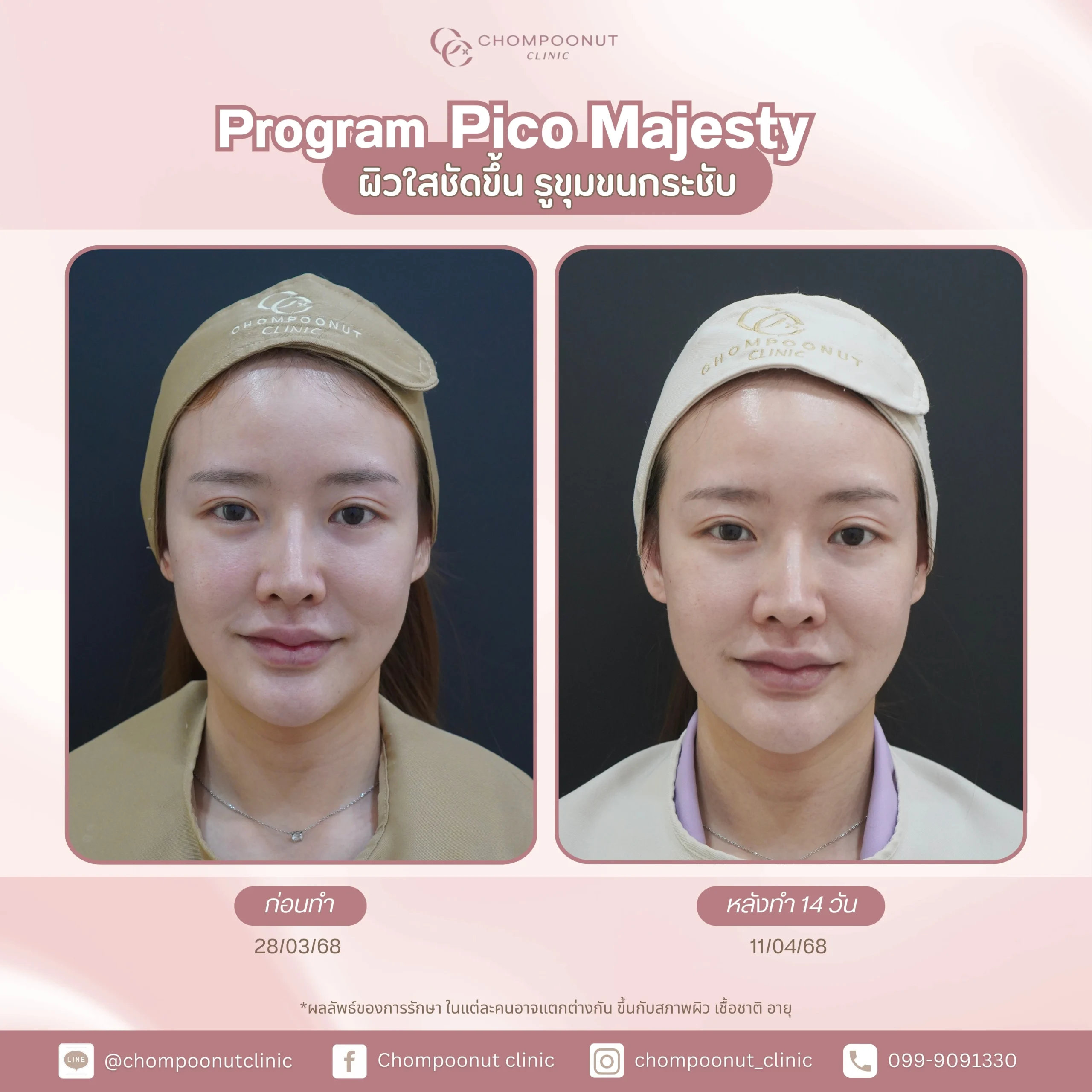 รีวิว Pico ฝ้า กระ ชมพูนุชคลินิค นครปฐมรีวิว Sculptra ชมพูนุชคลินิค นครปฐม