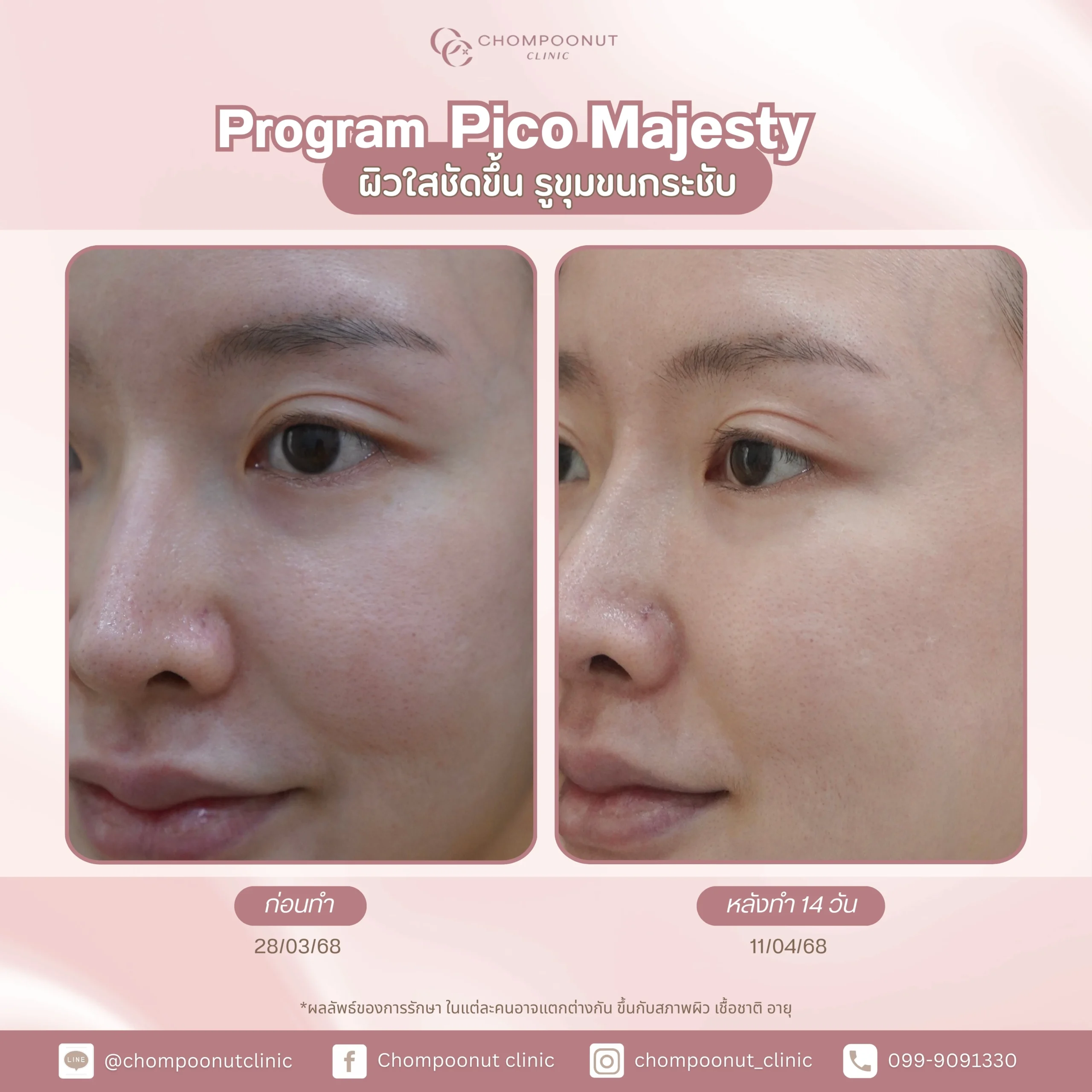 รีวิว Pico ฝ้า กระ ชมพูนุชคลินิค นครปฐมรีวิว Sculptra ชมพูนุชคลินิค นครปฐม