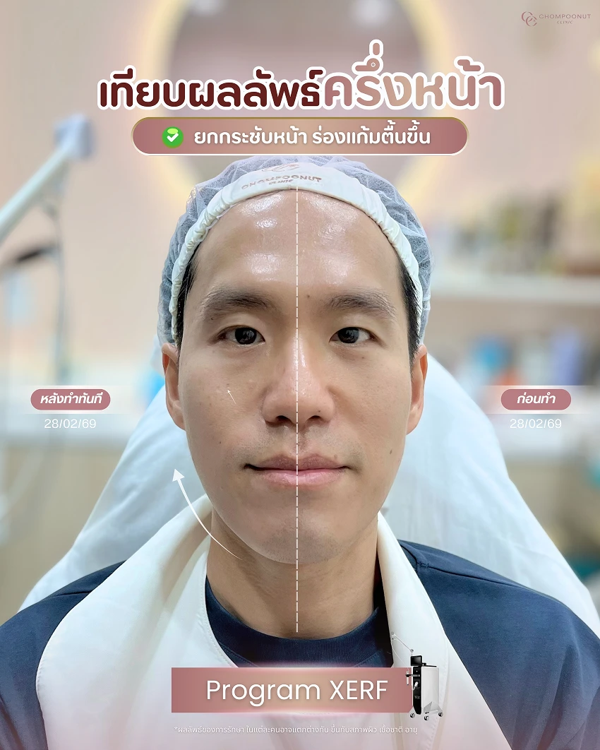 รีวิว XERF ชมพูนุชคลินิค นครปฐมรีวิว Sculptra ชมพูนุชคลินิค นครปฐม