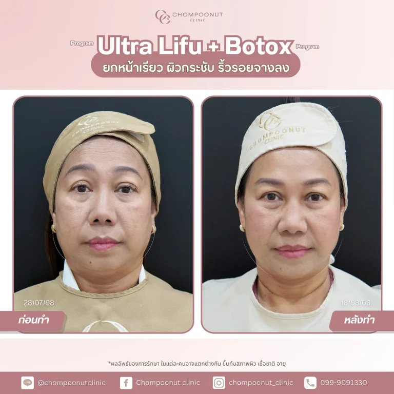 ภาพเปรียบเทียบความเปลี่ยนแปลง รีวิว Ultra LIFU + Botox ลดเลือนริ้วรอย