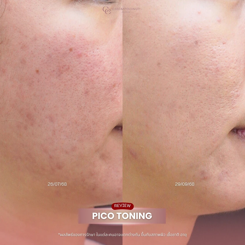 รีวิว Pico Majesty ฝ้า กระ ชมพูนุชคลินิค นครปฐมรีวิว Sculptra ชมพูนุชคลินิค นครปฐม