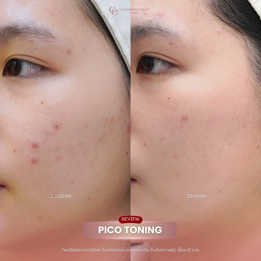 รีวิว Pico Majesty ฝ้า กระ ชมพูนุชคลินิค นครปฐมรีวิว Sculptra ชมพูนุชคลินิค นครปฐม