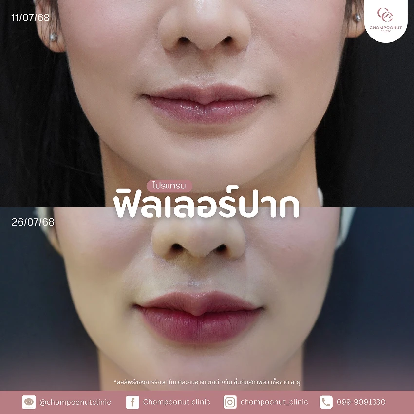 รีวิวฉีดฟีลเลอร์ปาก ชมพูนุชคลินิค นครปฐม ฉีดปาก