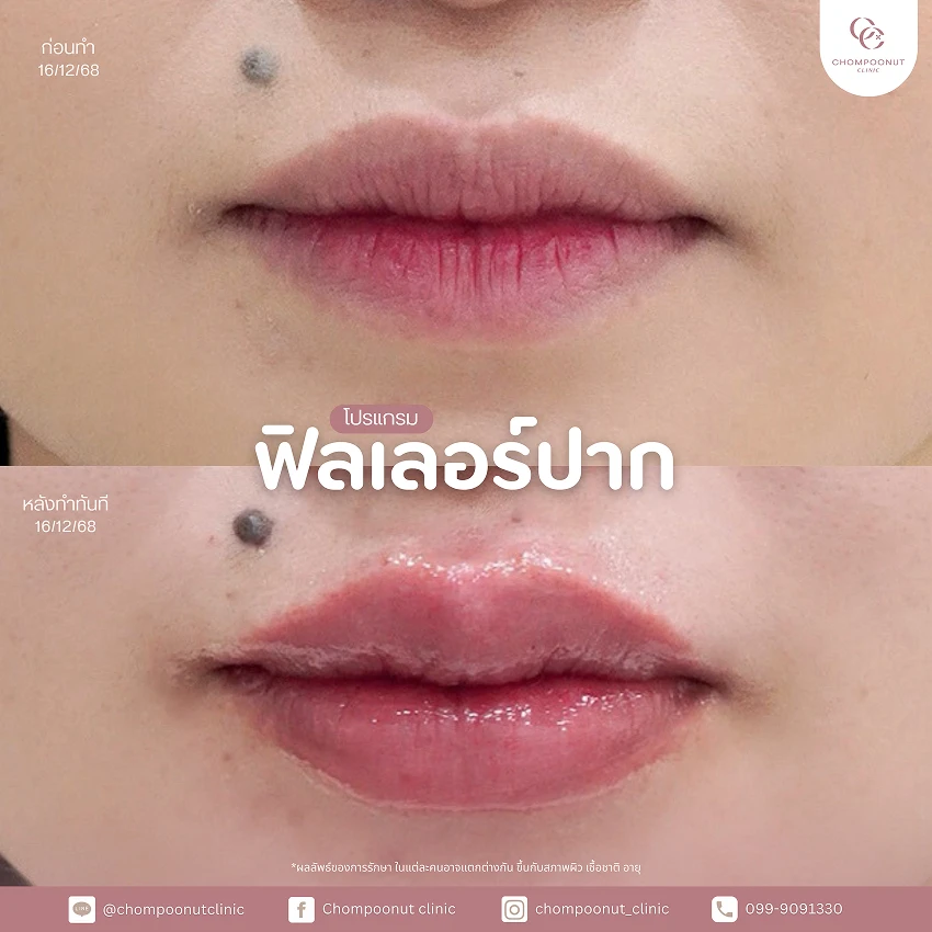 รีวิวฉีดฟีลเลอร์ปาก ชมพูนุชคลินิค นครปฐม ฉีดปาก