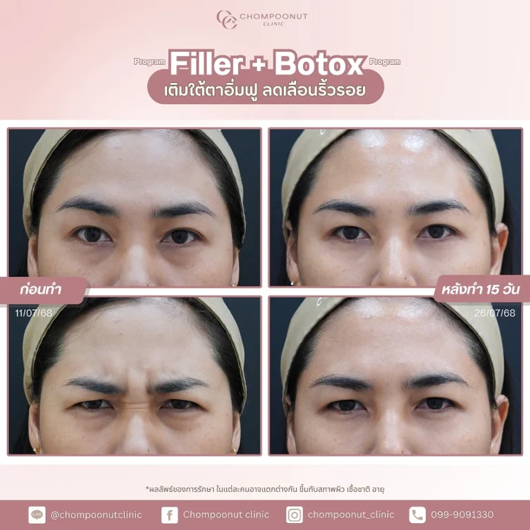 รีวิวฉีด โบท็อกซ์ ฟิลเลอร์ ชมพูนุชคลินิค นครปฐม Botox