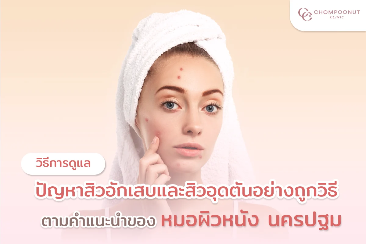 วิธีการดูแลปัญหาสิวอักเสบและสิวอุดตันอย่างถูกวิธี ตามคำแนะนำของ หมอผิวหนัง นครปฐม