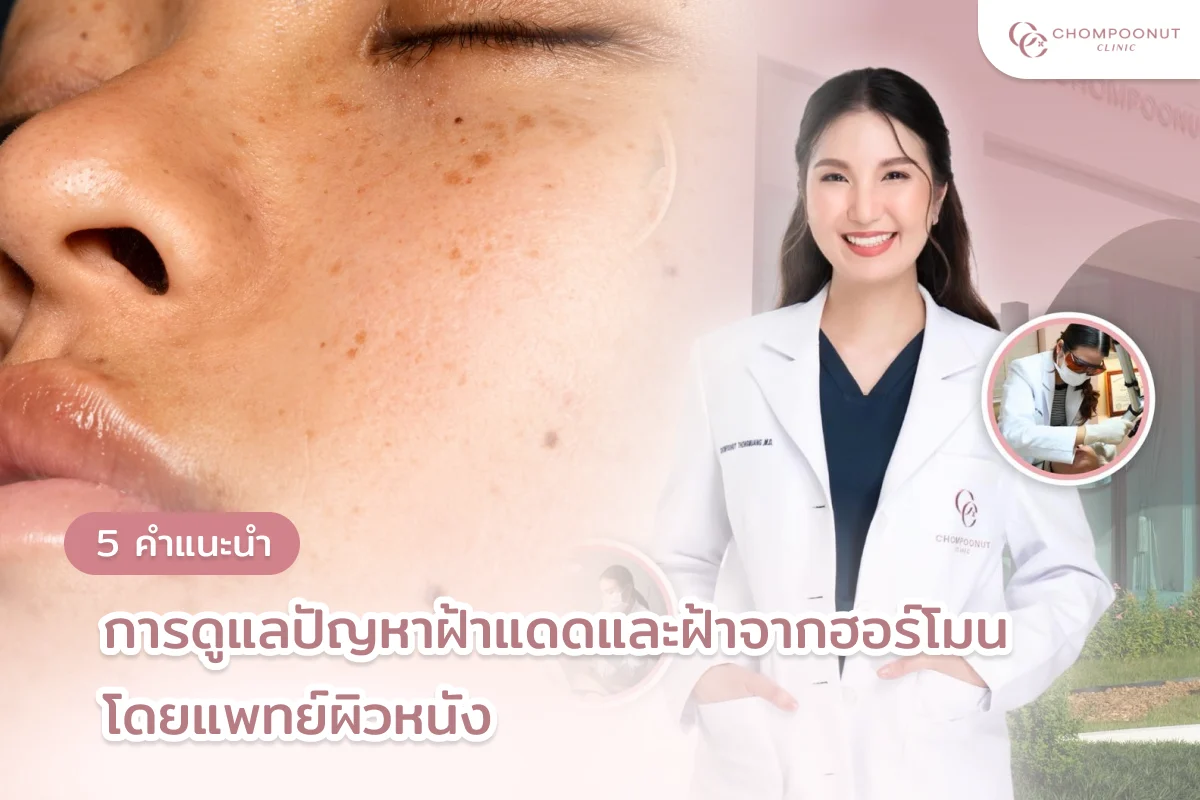 5 คำแนะนำดูแลปัญหาฝ้าแดด ฝ้าจากฮอร์โมน โปรแกรม Pico Majesty