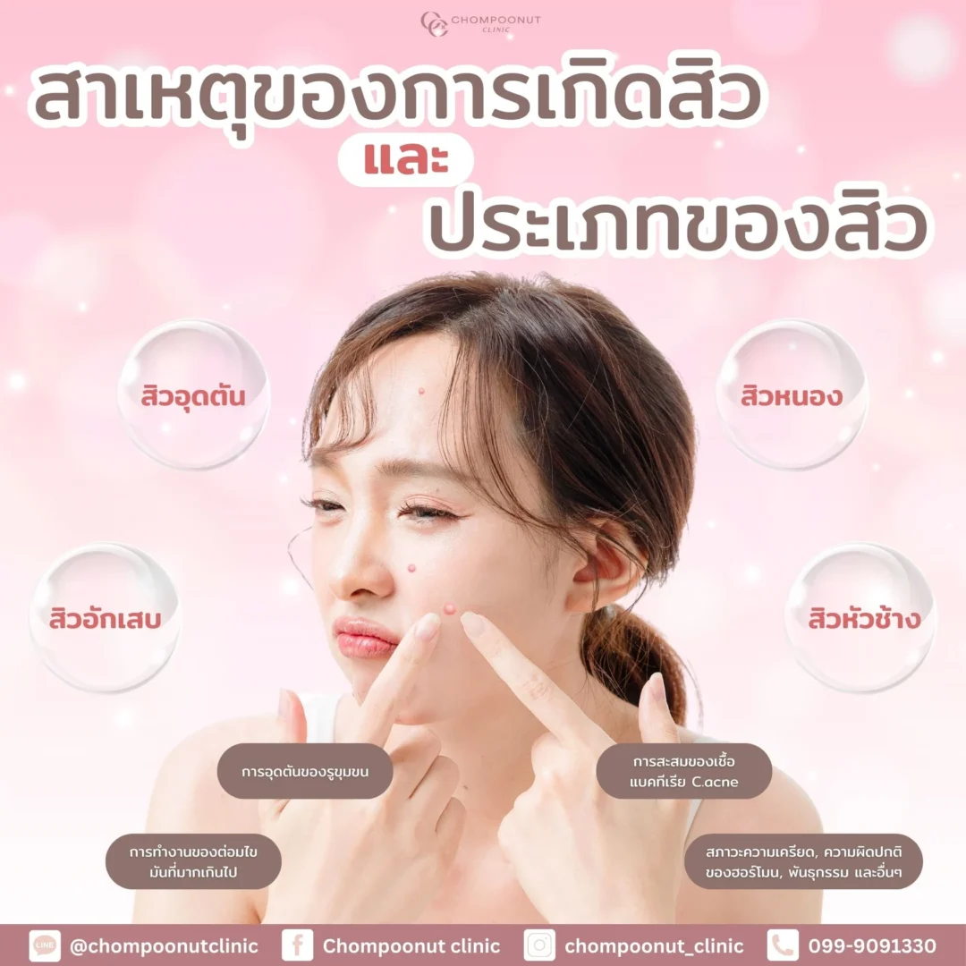 วิธีดูแลสิวอักเสบและสิวอุดตัน ตามคำแนะนำหมอผิวหนัง นครปฐม