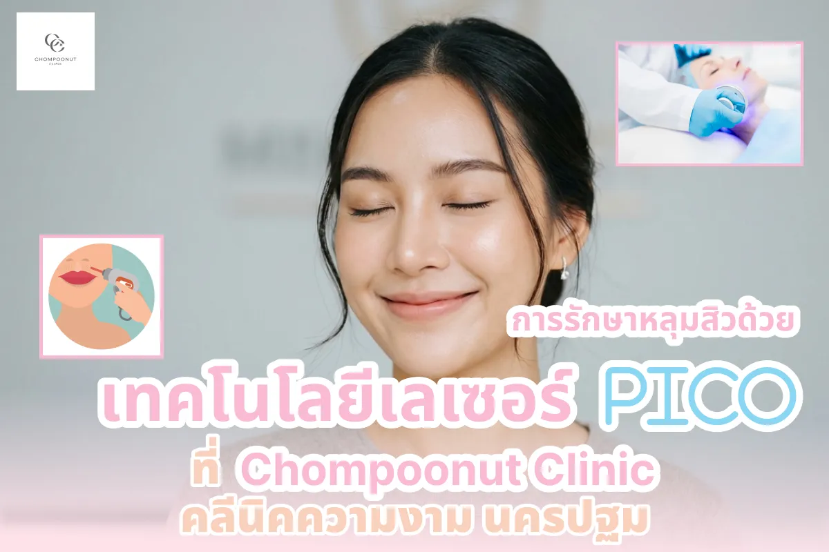 การรักษาหลุมสิวด้วยเทคโนโลยีเลเซอร์ Pico ที่ Chompoonut Clinic คลีนิคความงาม นครปฐม