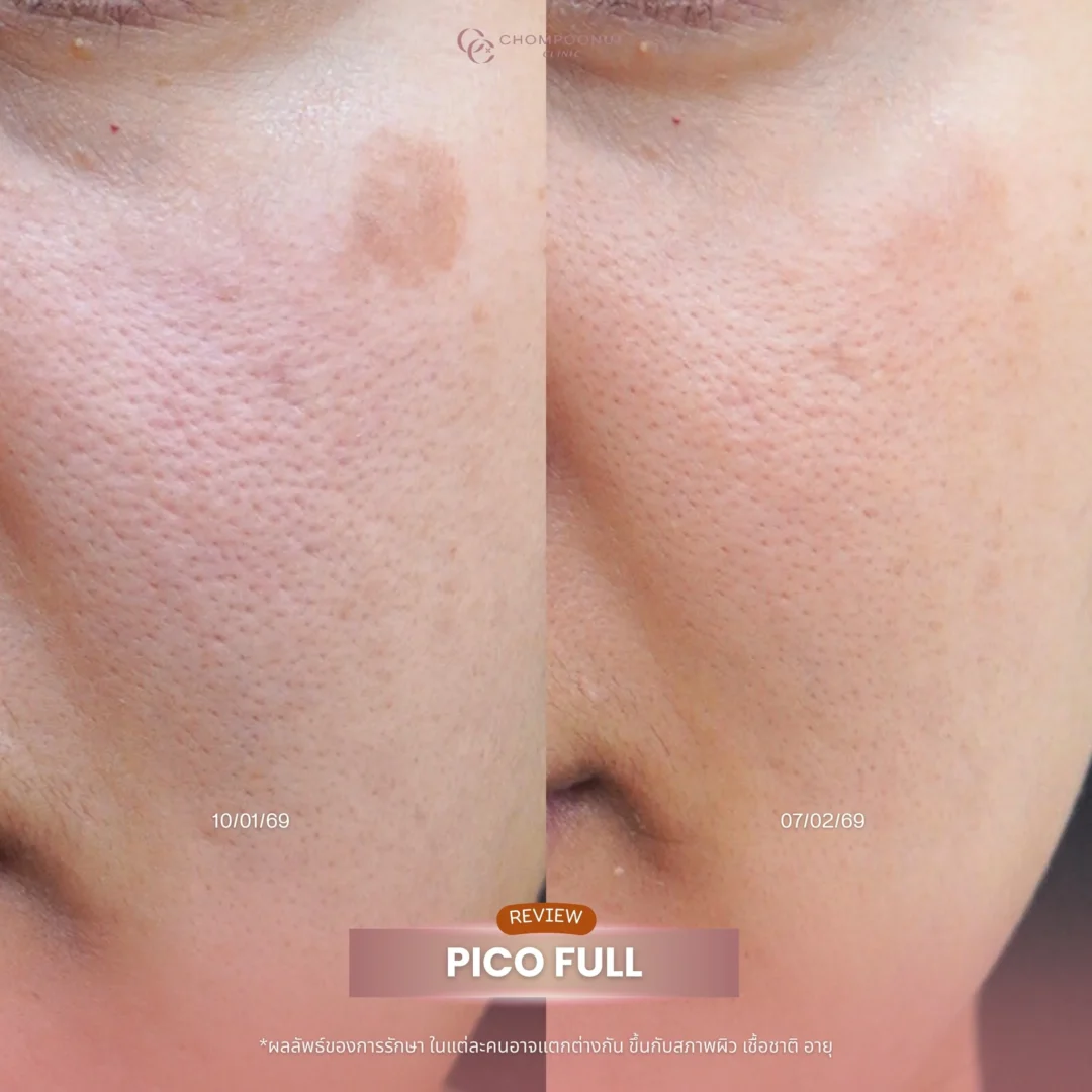 รีวิวรักษาฝ้า 5 คำแนะนำดูแลปัญหาฝ้าแดด ฝ้าจากฮอร์โมน โปรแกรม Pico Majesty