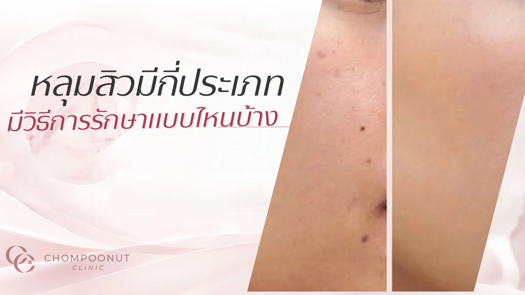 หลุมสิวมีกี่ประเภท มีวิธีการรักษาแบบไหนบ้าง
