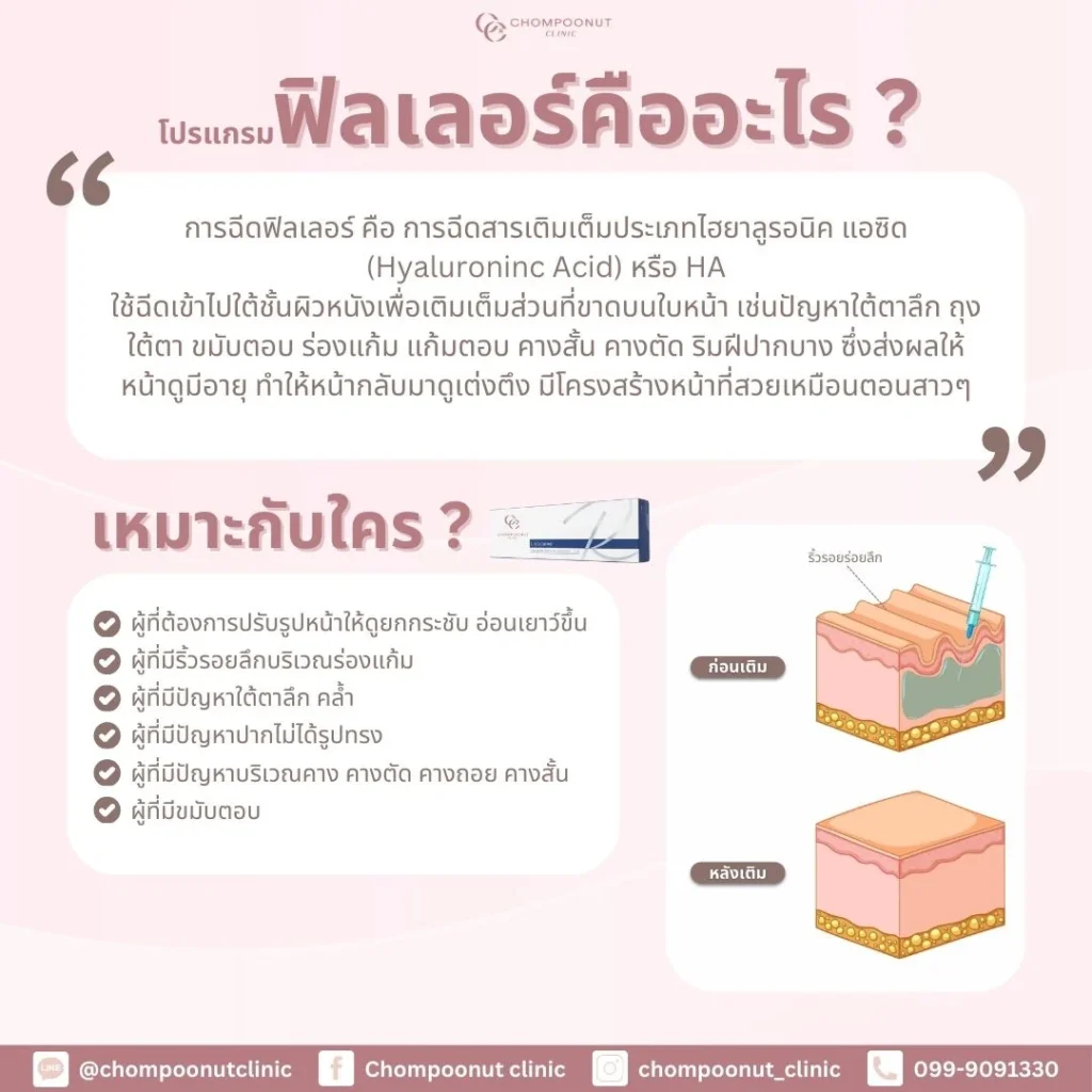 Program Filler คืออะไร เหมาะกับใครบ้าง? ปรับรูปหน้าสวยละมุนที่ คลินิกความงาม นครปฐม​