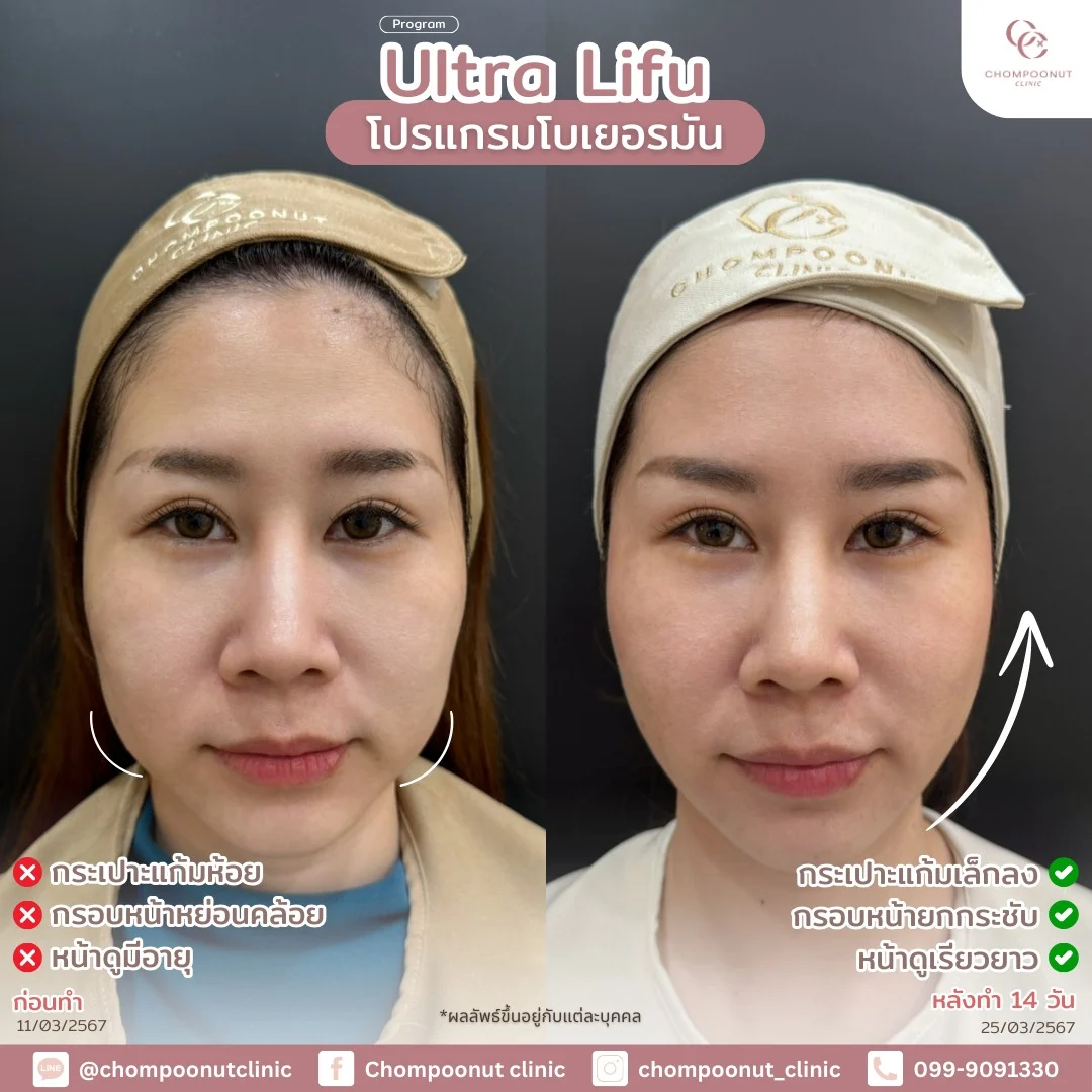 รีวิวที่จริงใจ โปรแกรม Lifu ทำหน้า นครปฐม