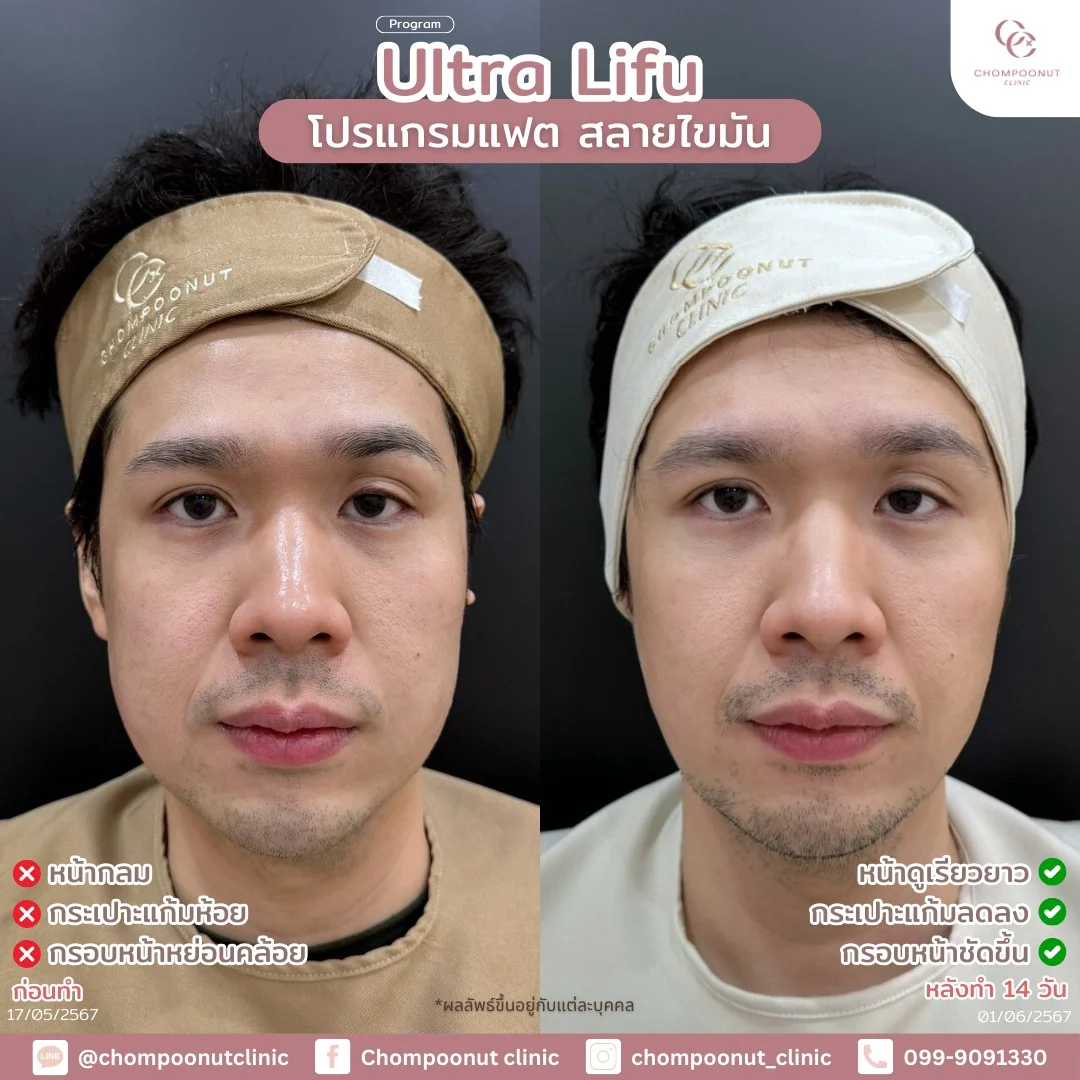 รีวิวที่จริงใจ โปรแกรม Lifu ทำหน้า นครปฐม