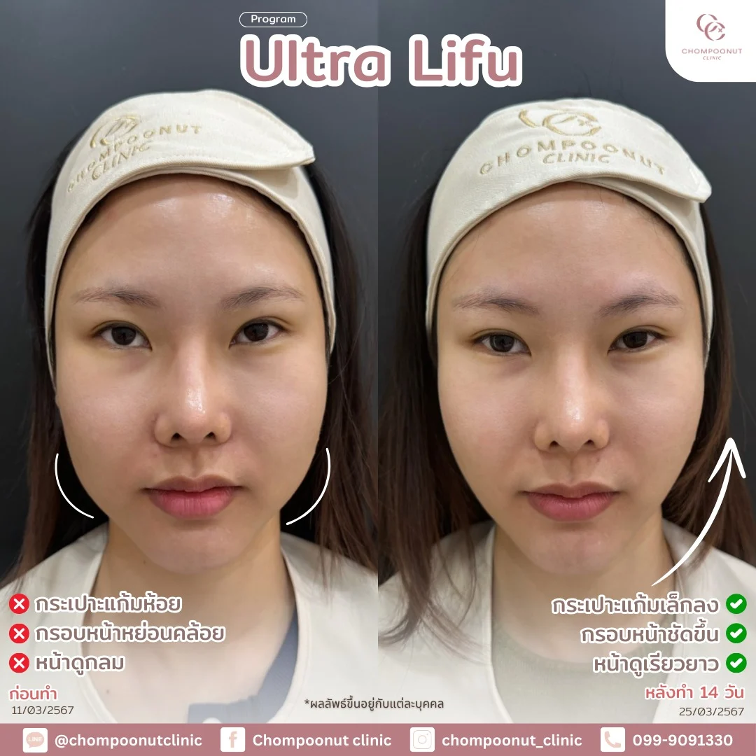 รีวิวที่จริงใจ โปรแกรม Lifu ทำหน้า นครปฐม