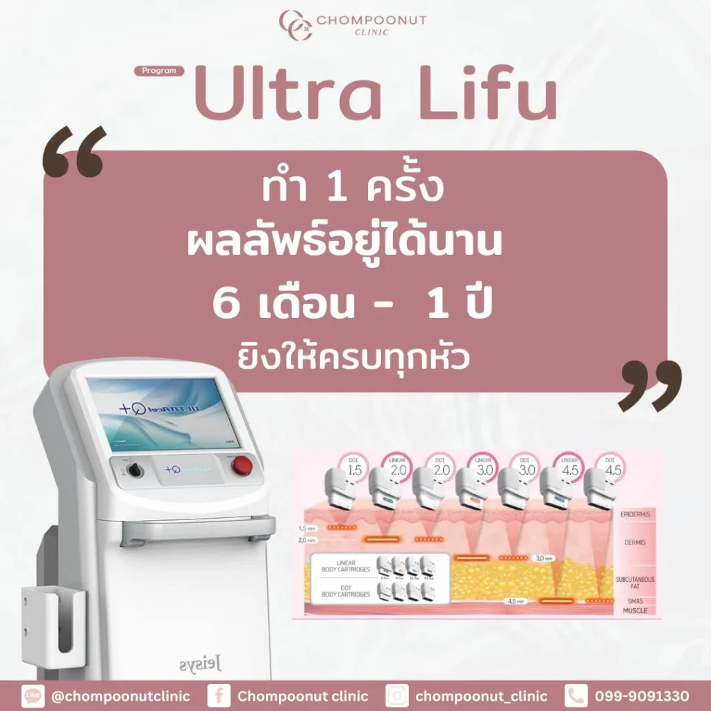 Program Ultra Lifu ทำ 1 ครั้ง ผลลัพธ์อยู่ได้นาน 6 เดือน – 1 ปี จริงไหม? เจาะลึกเทคโนโลยียกกระชับผิว