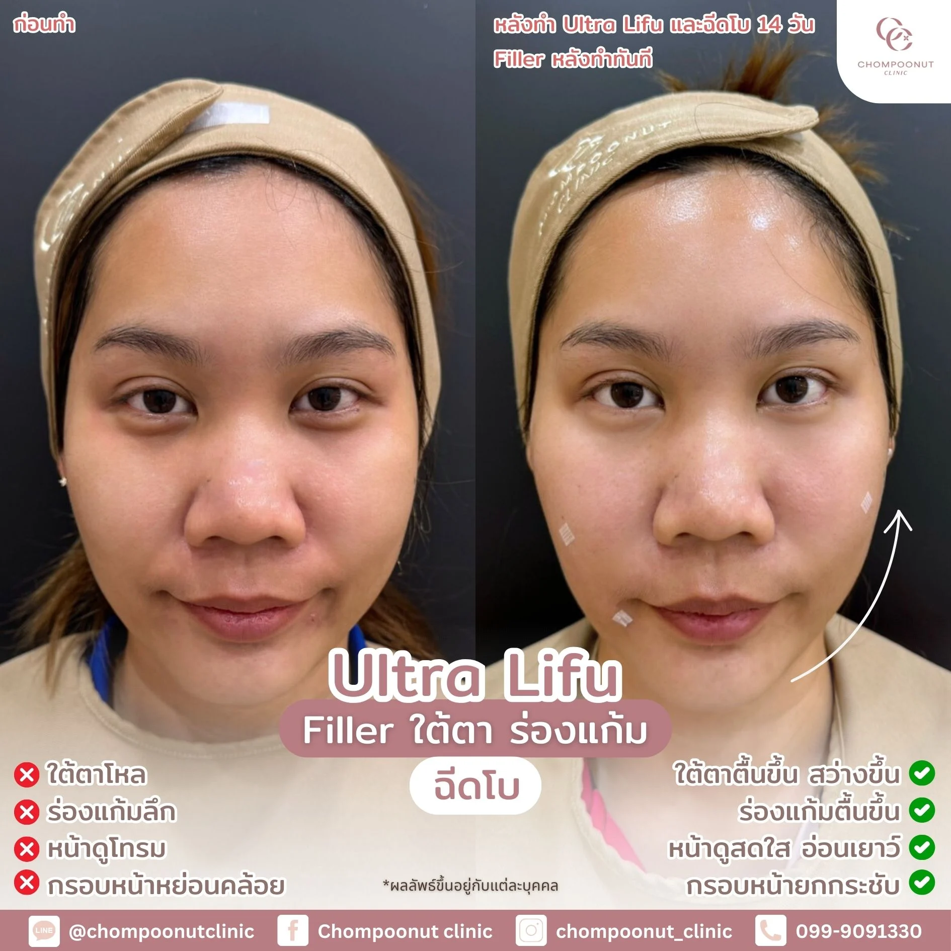 รีวิวที่จริงใจ โปรแกรม Lifu ทำหน้า นครปฐม