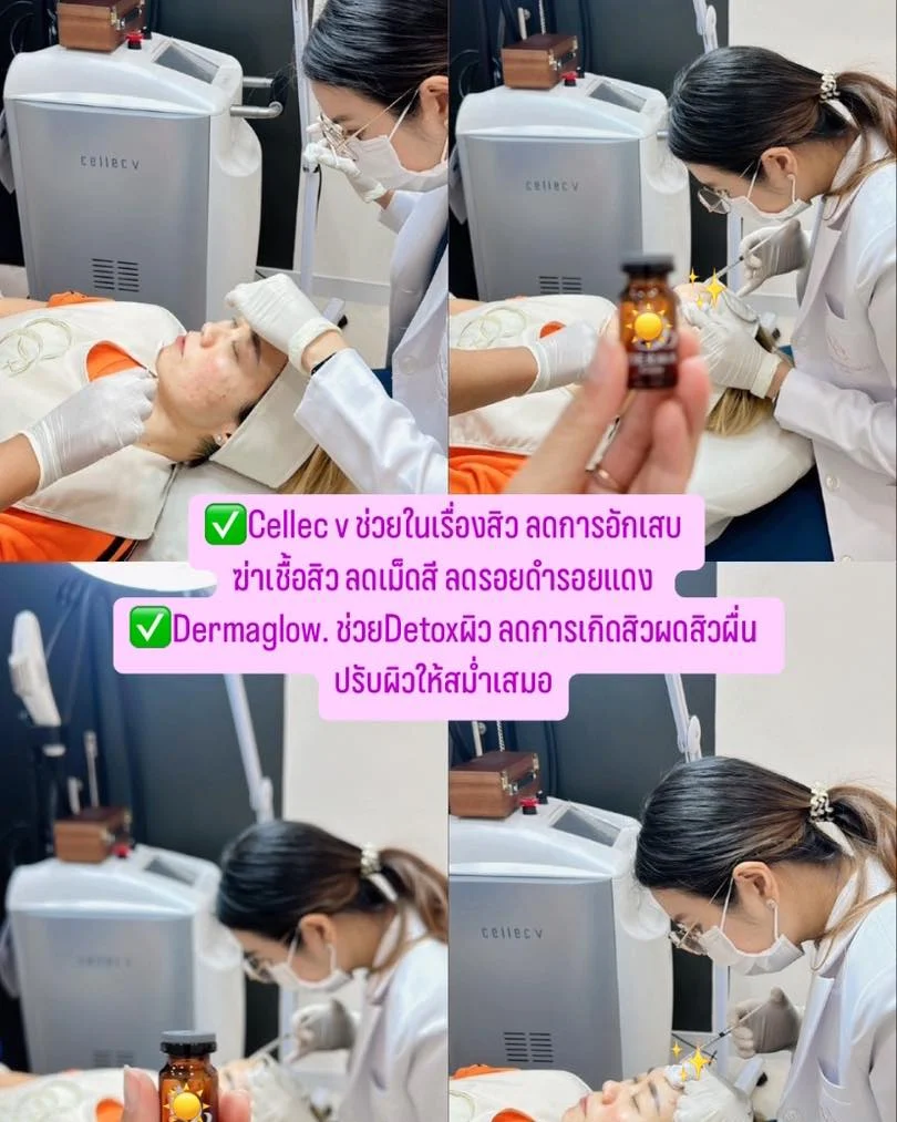 บอกลาปัญหาสิว เผยผิวหน้าใสไร้สิว คอสที่สาวๆ ตกหลุมรักด้วยโปรแกรม Cellec V และ Dermaglow