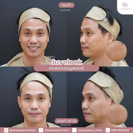 รีวิวที่จริงใจ โปรแกรม Juvelook ทำหน้า นครปฐม