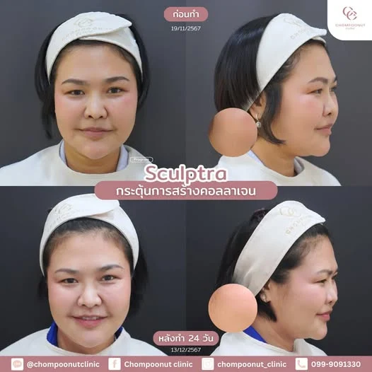 ผลลัพธ์การฟื้นฟูผิวด้วยคอลลาเจนกระตุ้นธรรมชาติที่ Chompoonut Clinic
