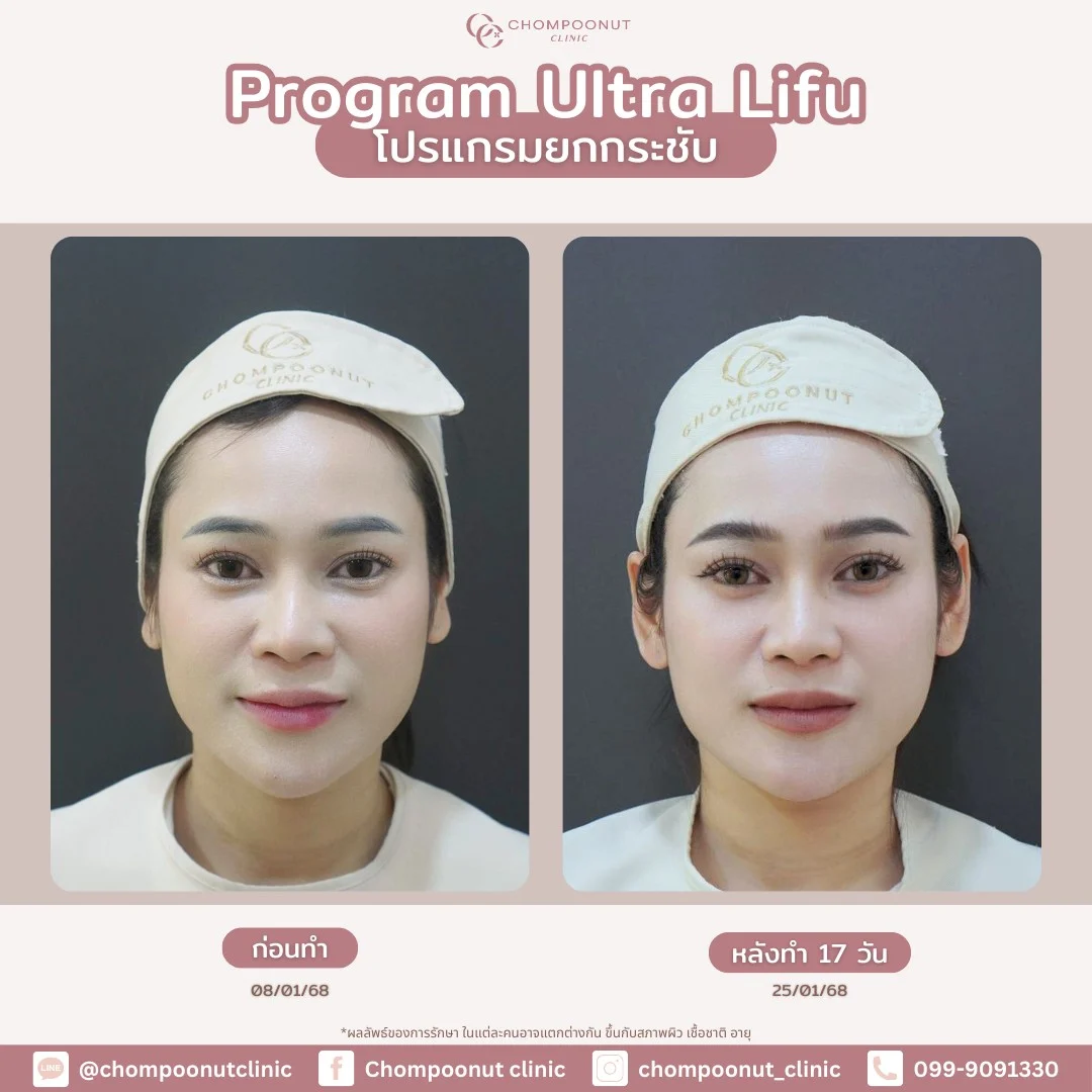 รีวิวที่จริงใจ โปรแกรม Lifu ทำหน้า นครปฐม