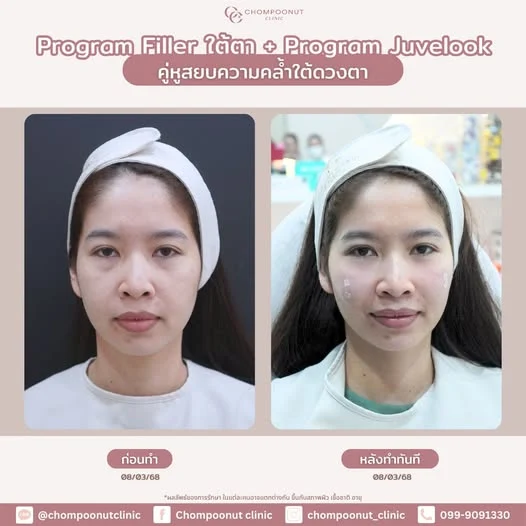 รีวิว โปรแกรมฟิลเลอร์ใต้ตา และ โปรแกรม Juvelook จับคู่ความสวยที่ลงตัว