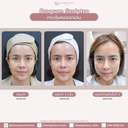 เปรียบเทียบก่อนและหลังทำหัตถการปรับโครงสร้างผิว โดยแพทย์เฉพาะทางผิวหนัง