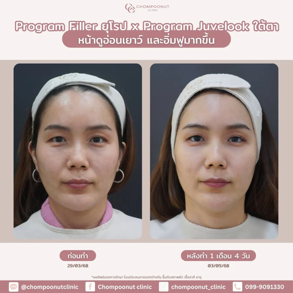 รีวิว โปรแกรมฟิลเลอร์ใต้ตา และ โปรแกรม Juvelook จับคู่ความสวยที่ลงตัว