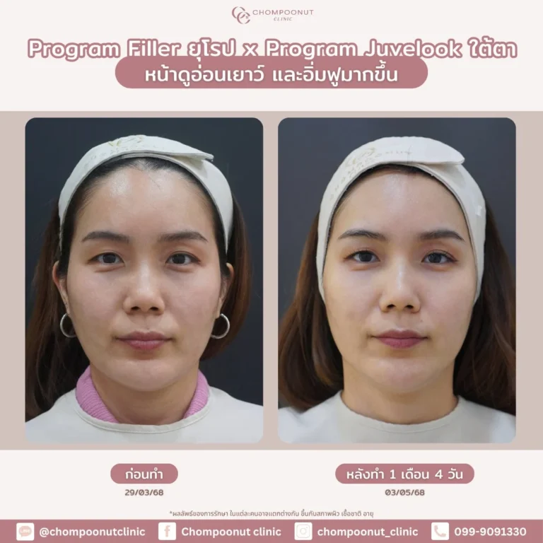 รีวิว โปรแกรมฟิลเลอร์ใต้ตา และ โปรแกรม Juvelook จับคู่ความสวยที่ลงตัว