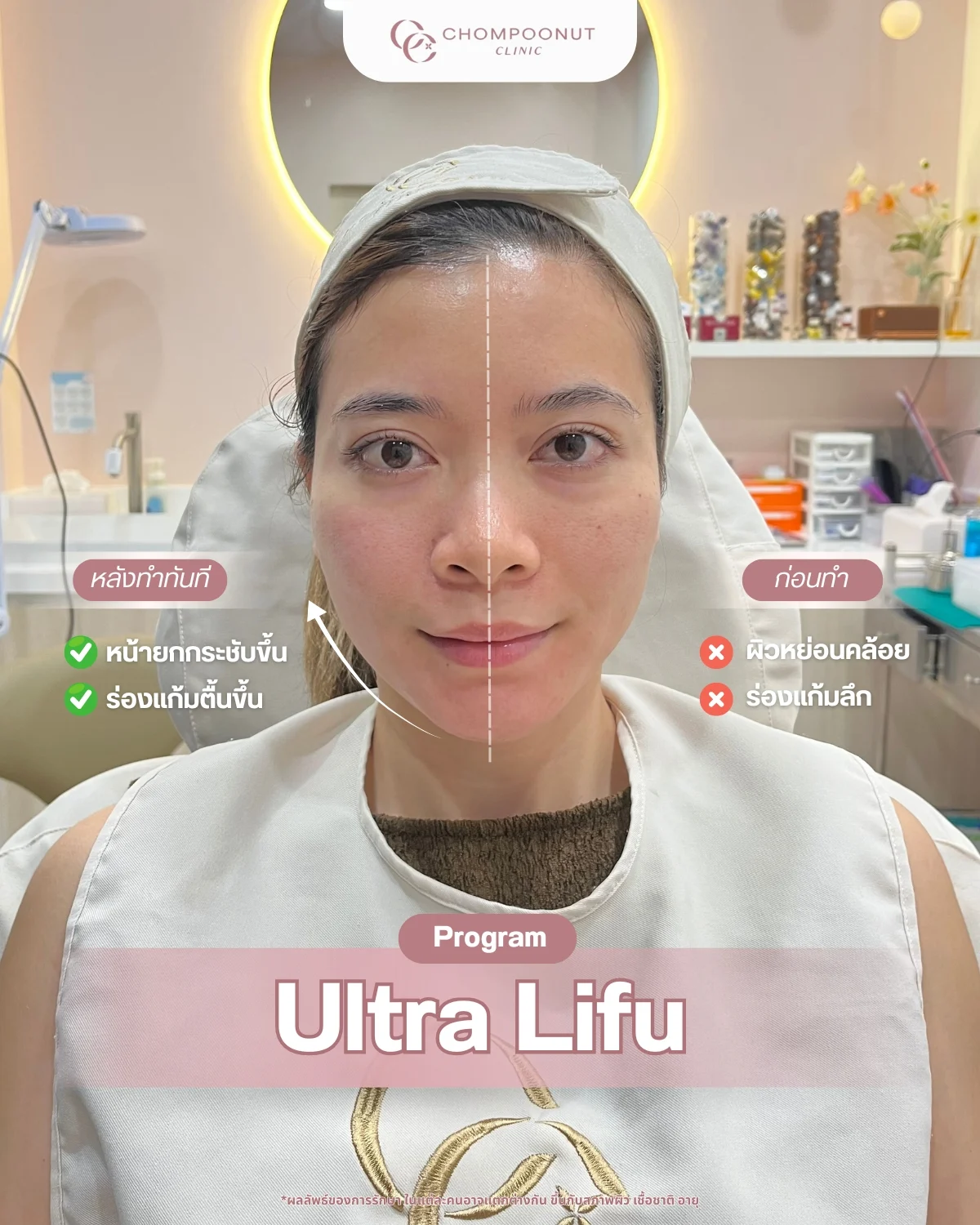 รีวิวที่จริงใจ โปรแกรม Lifu ทำหน้า นครปฐม