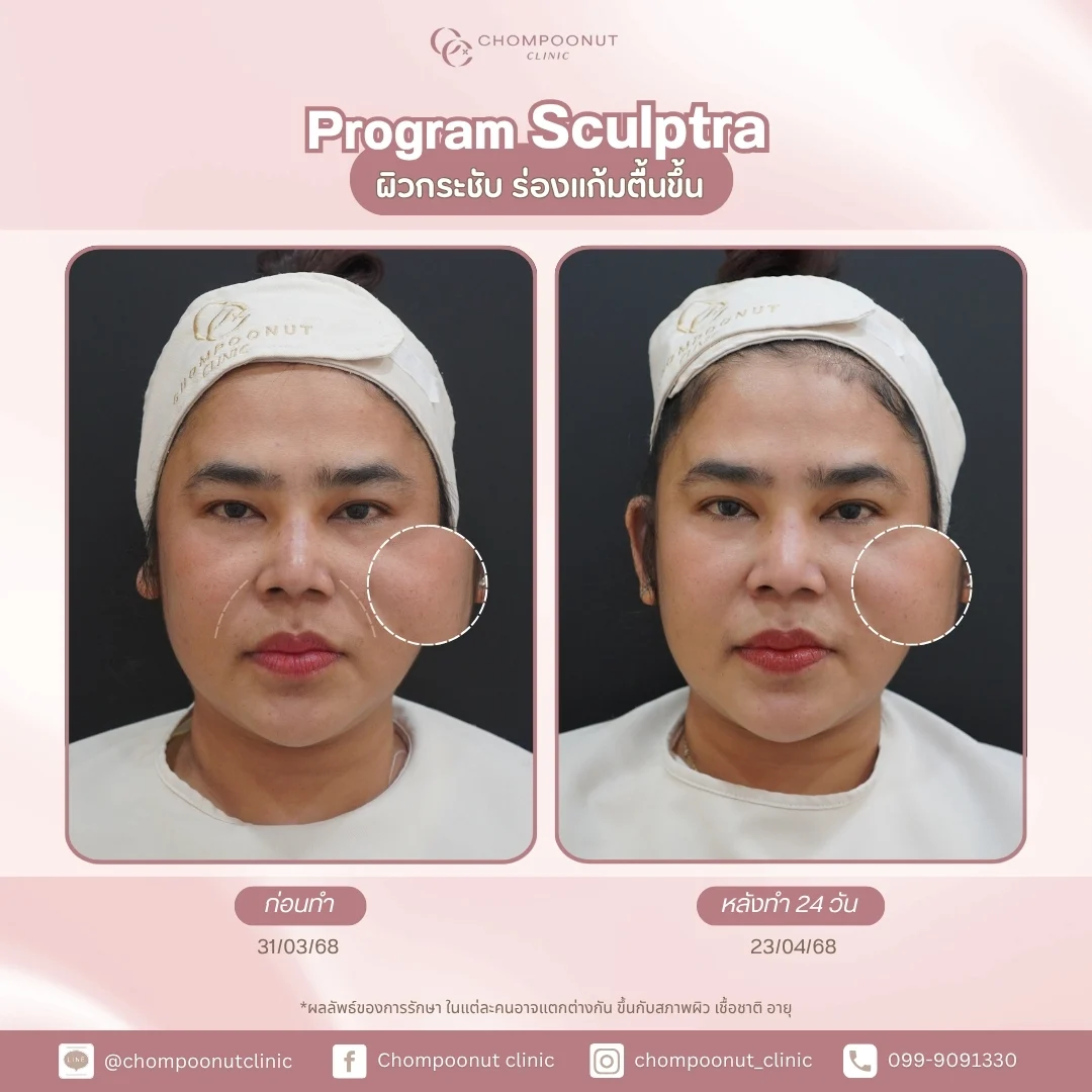รีวิวที่จริงใจ โปรแกรม sculptra ทำหน้า นครปฐม