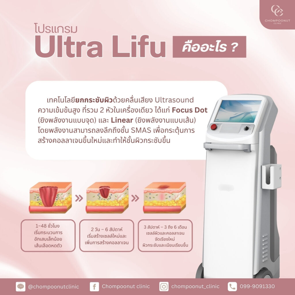 โปรแกรม Lifu คืออะไร? นวัตกรรมยกกระชับหน้า เรียว วีเชฟ ไม่ต้องผ่าตัด