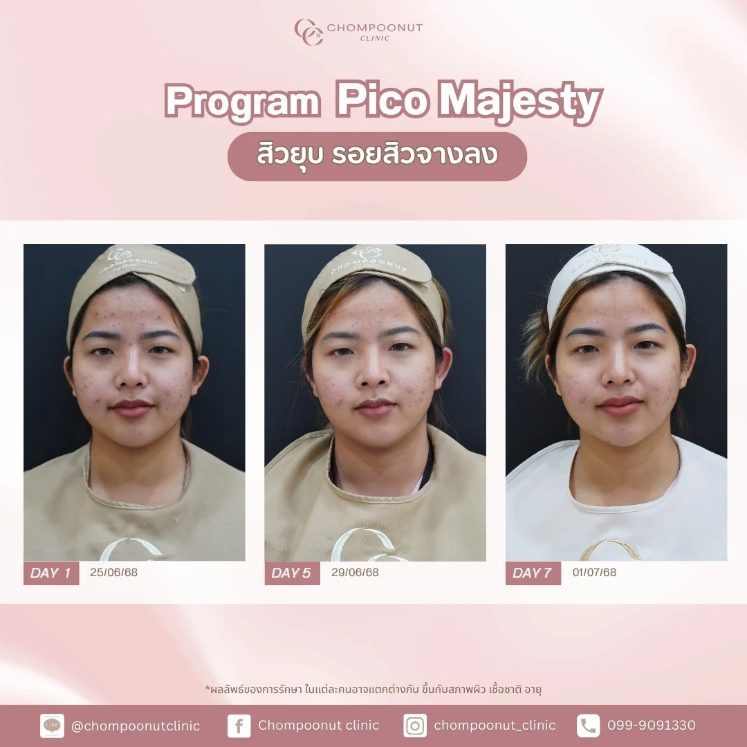 ผิวหน้าเนียนใสหลังทำเลเซอร์ Pico