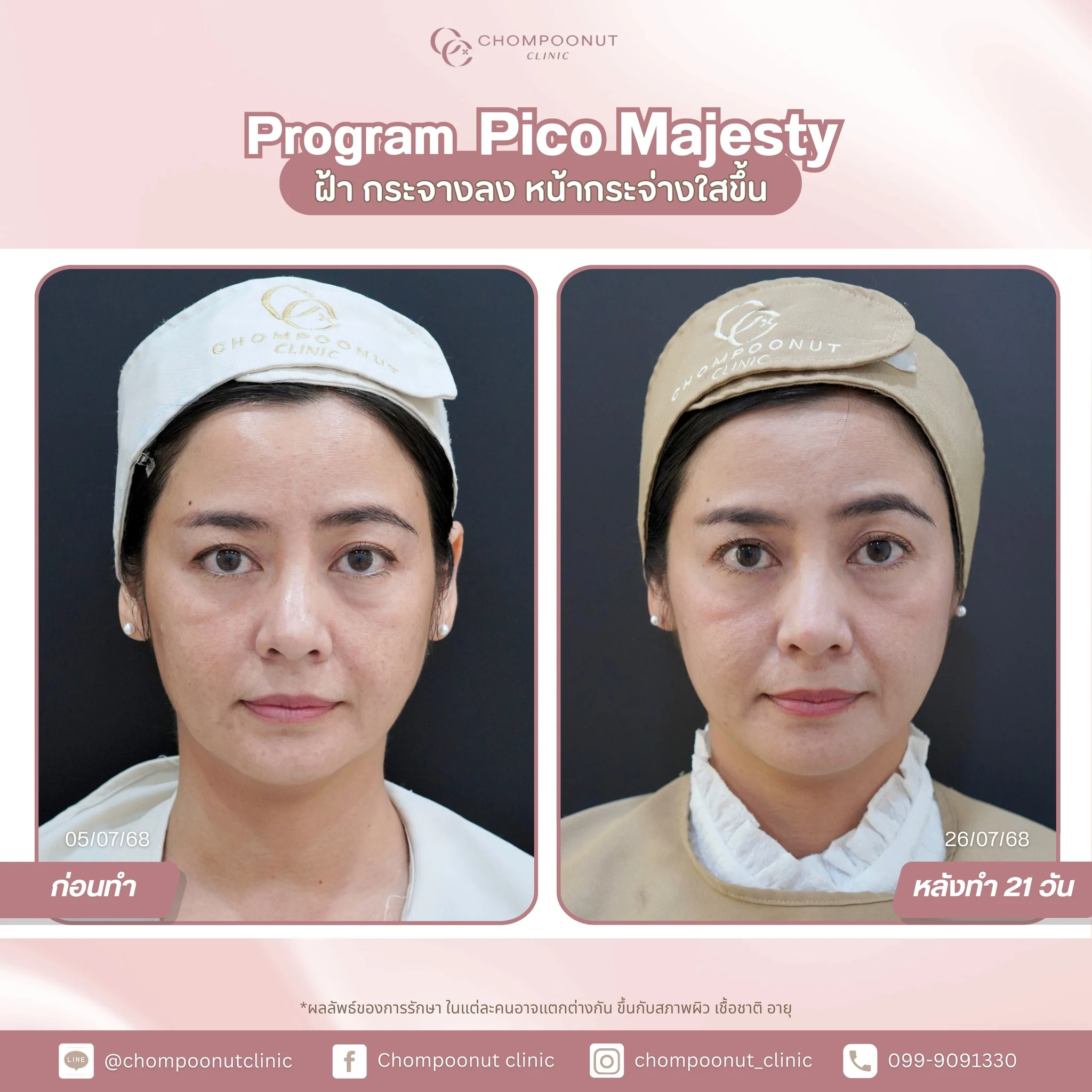 เปรียบเทียบก่อน-หลัง รักษาหลุมสิวด้วยเลเซอร์ Pico