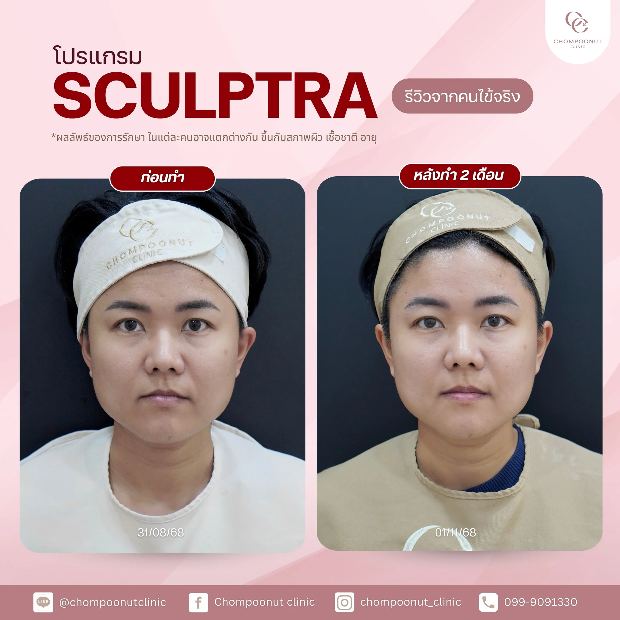 คนไข้จริงหลังทำหัตถการกระตุ้นคอลลาเจน ผิวหน้าดูกระชับและเรียบเนียนขึ้น