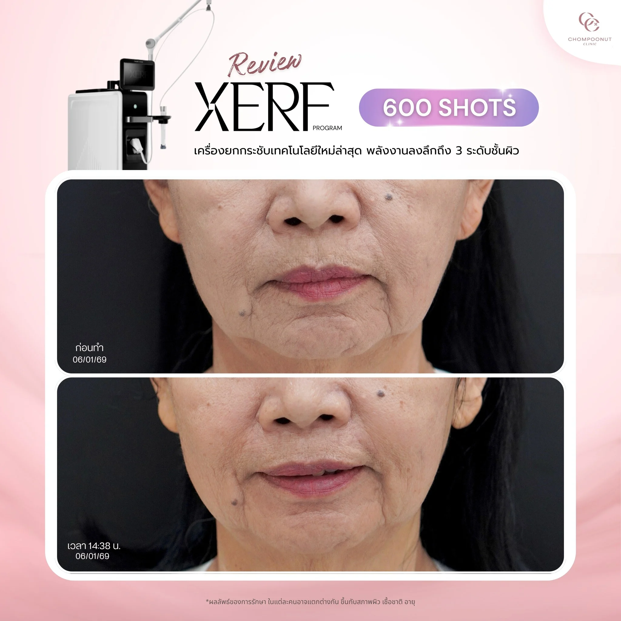 ผิวเรียบเนียน รูขุมขนกระชับด้วยนวัตกรรม XERF นครปฐม